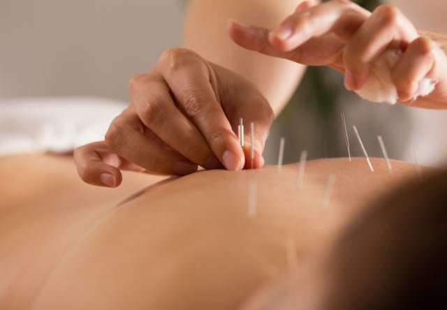 Acupuncture Therapy Acupuncture Therapy